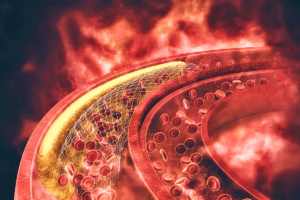Read more about the article Colesterol alto – O que causa? Como tratar? Veja agora